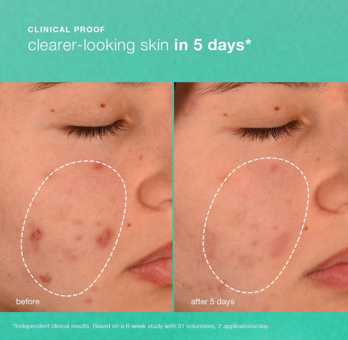 Breakout Biotic Moisturizer_PDP_tiles_R6BA 1